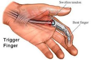 How do you know if you need trigger finger surgery?