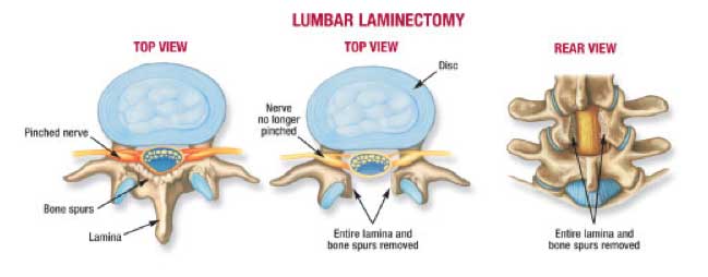 Lumbar Laminectomy - Open - St. George Surgical Center